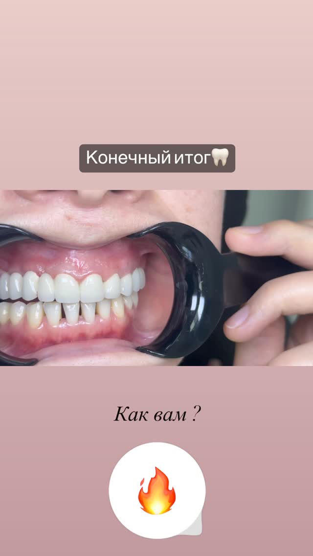 Имплантация