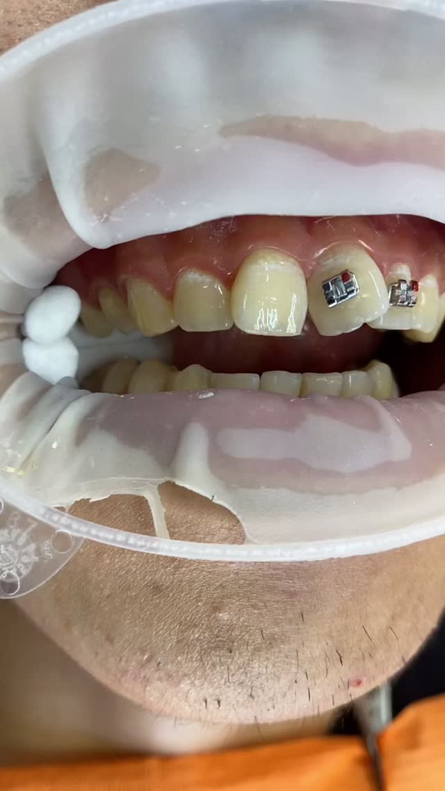 Брекеты ортодонтия Бишкек