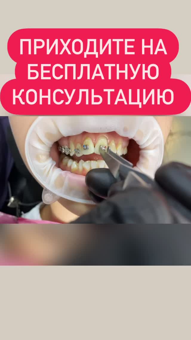 Брекеты (ортодонтия)