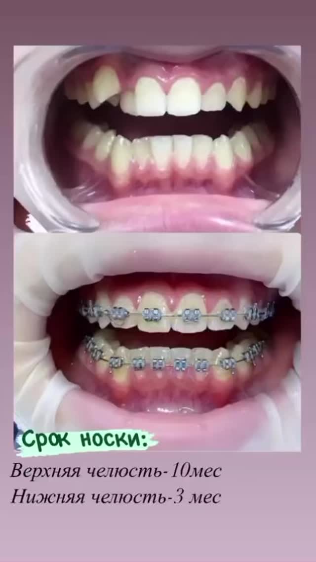 Брекеты этапы