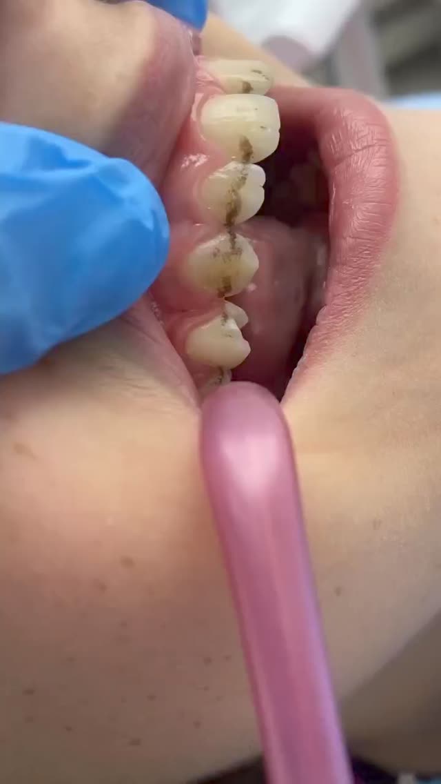 Чистка зубов этап 1