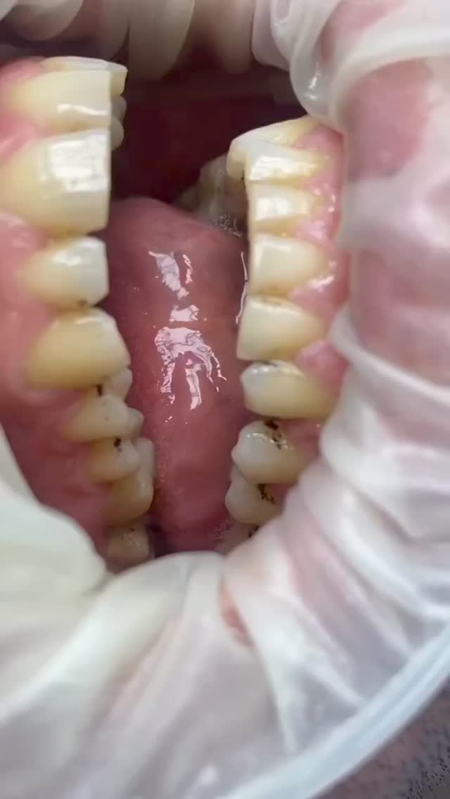 Чистка зубов этап 2