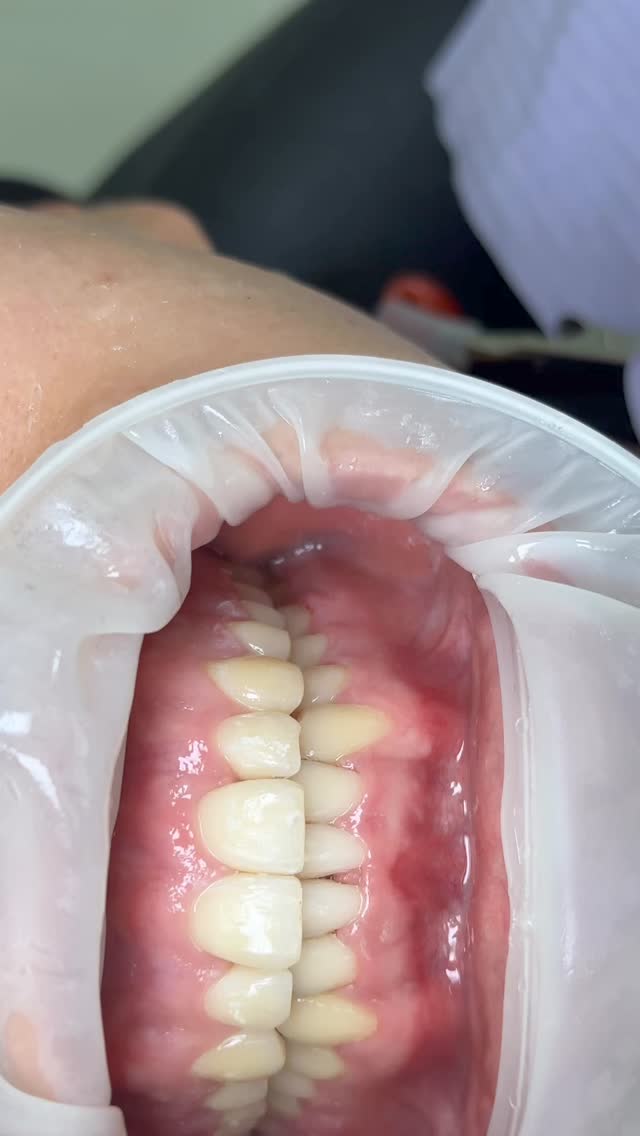 Чистка зубов этап 3