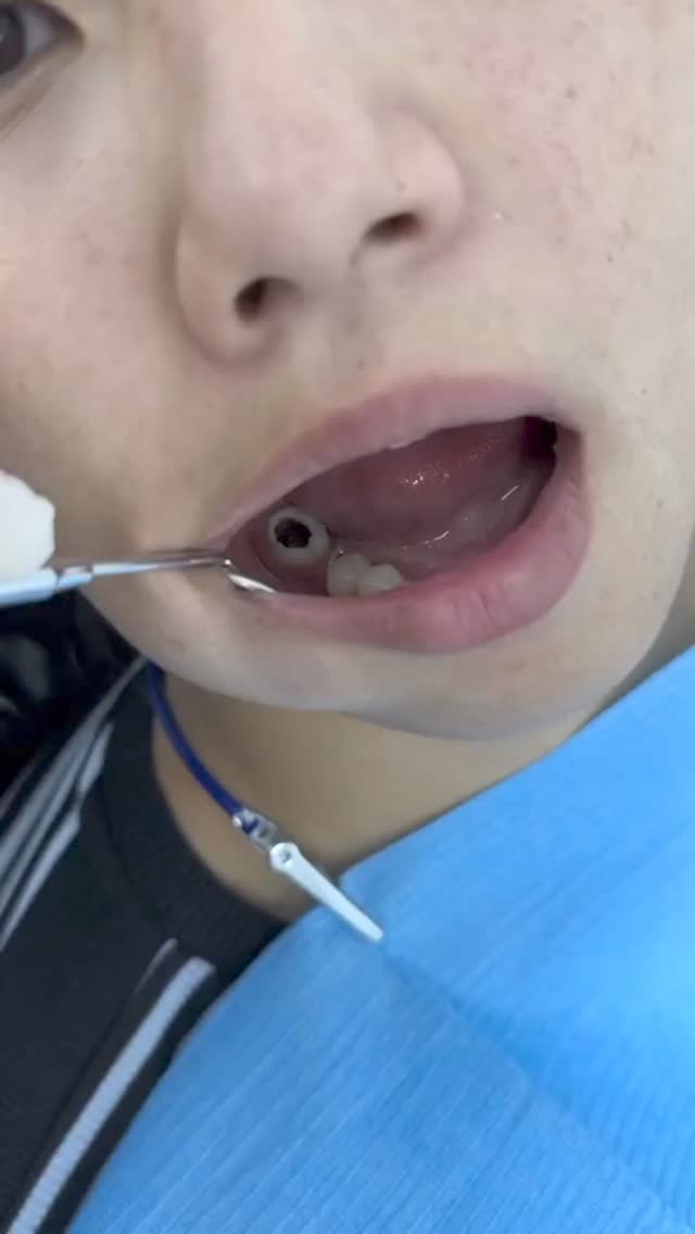 Пломба результат