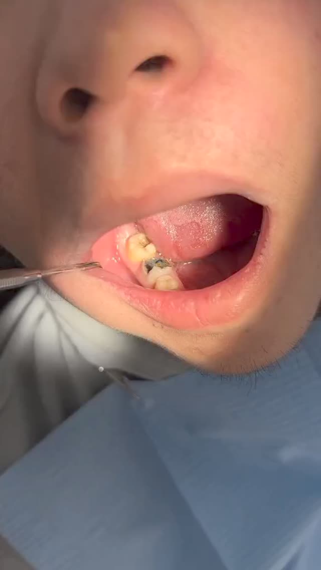 Пломбирование до после