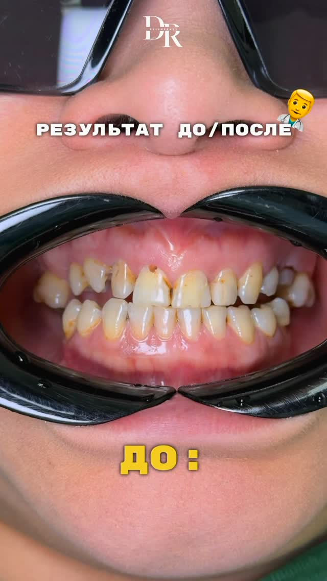 Результат имплантации